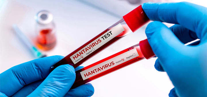 Hantavirus Explained: What To Know
